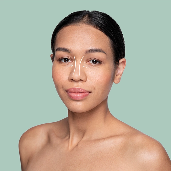 Procedimiento estético para la nariz